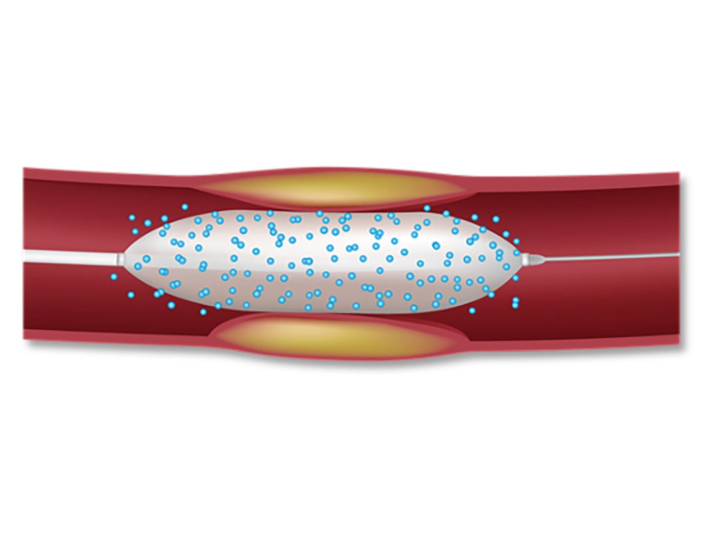 Drug released from a drug-coated balloon in the vessel to treat challenging coronary anatomy.