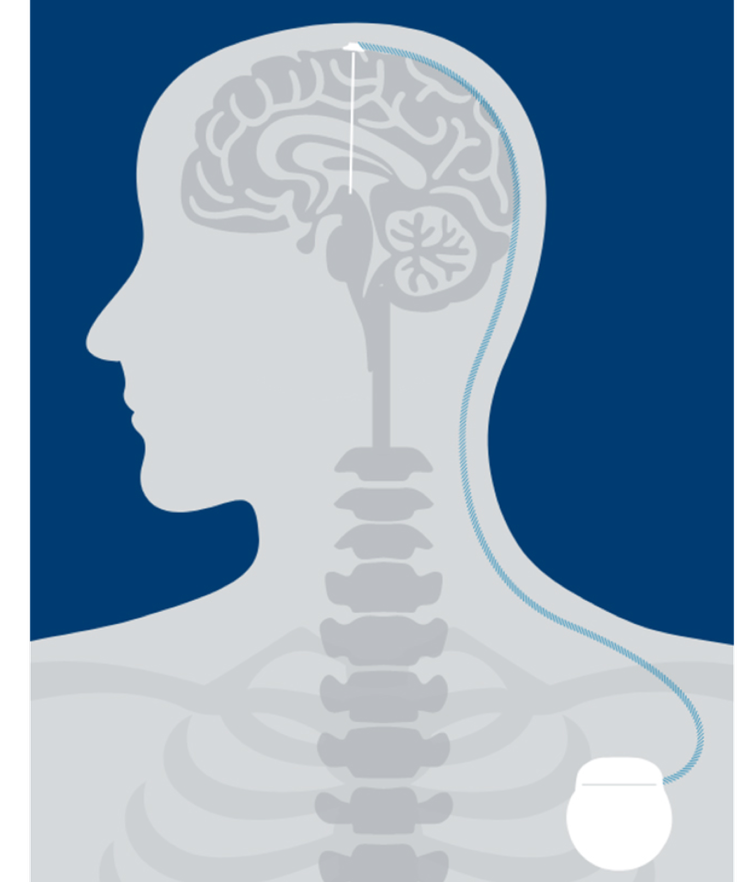 How Deep Brain Stimulation works - Boston Scientific