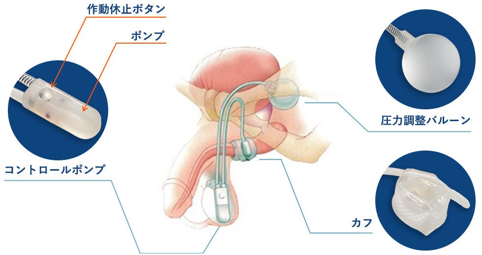 3つのパーツで構成され、圧媒液（生食）の移動を効果的に使ったシリコーン製デバイス
