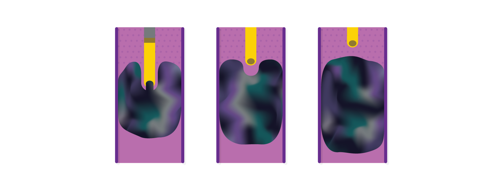 Obsidio Conformable Embolic time insensitive.