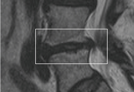 MRI scan showing spinal vertebrae with highlighted region indicating modic changes.