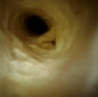 Clinical image of cystic duct take-off.