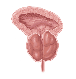 Próstata agrandada