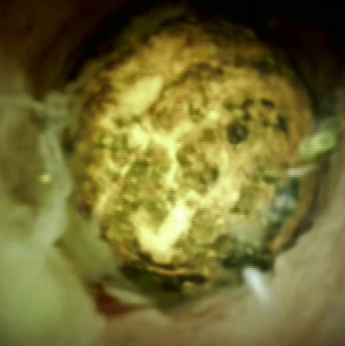 Clinical image of a stone on its own.