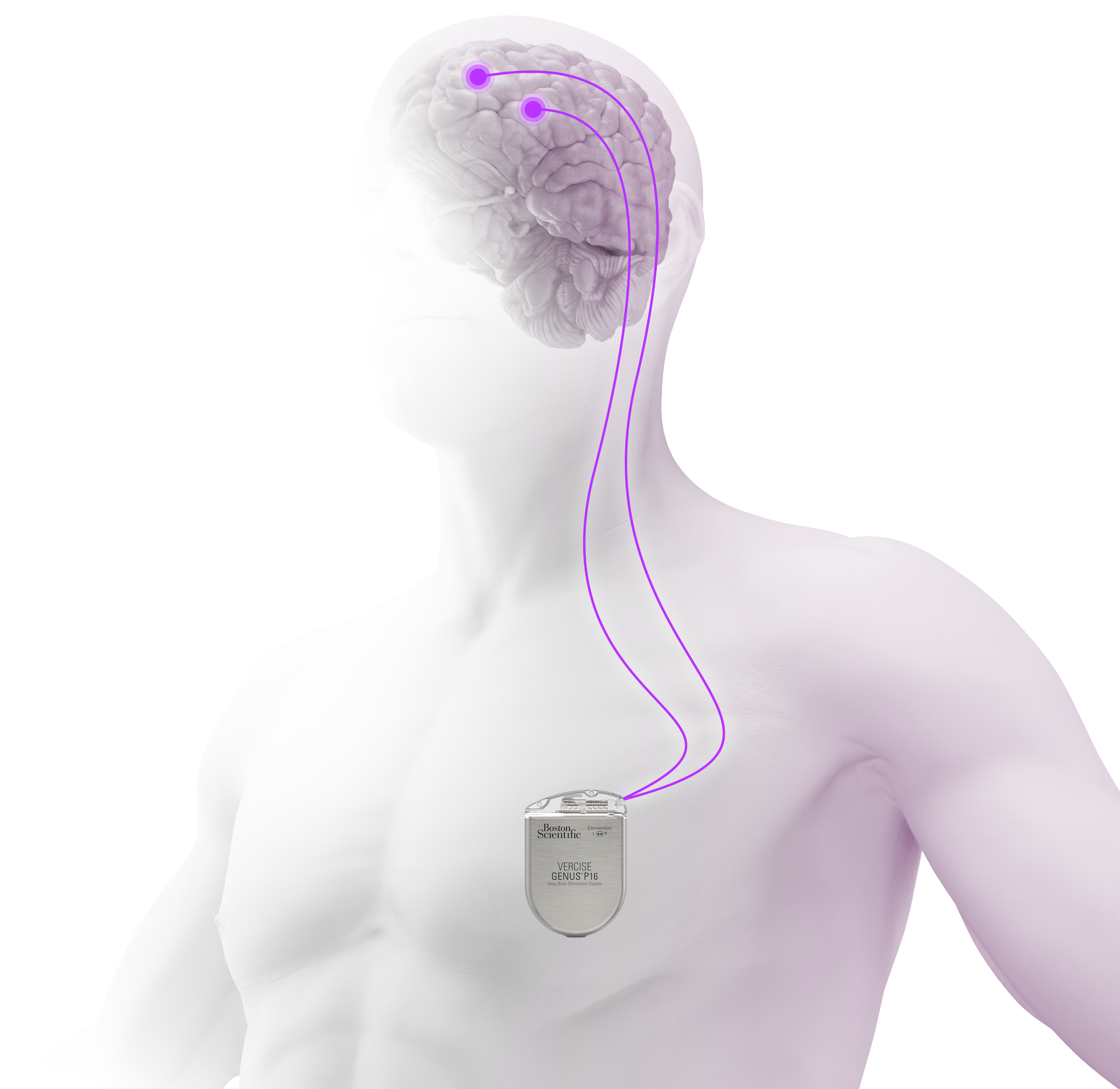 Person with dbs stimulator highlighted.