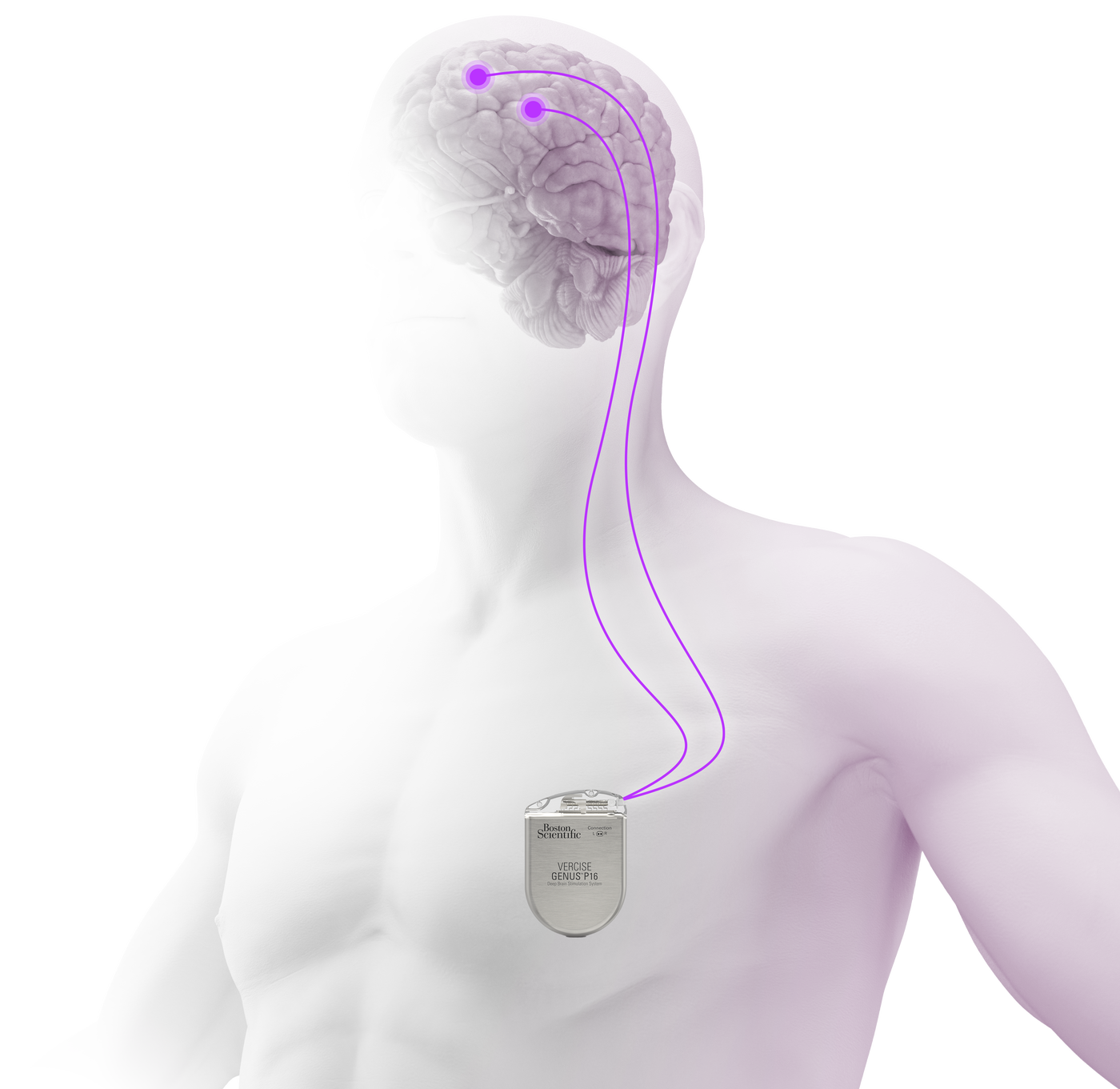 Deep Brain Stimulation (DBS) - Boston Scientific