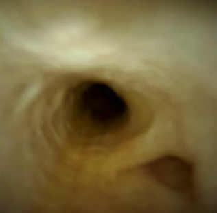 Clinical image of cystic duct take-off.