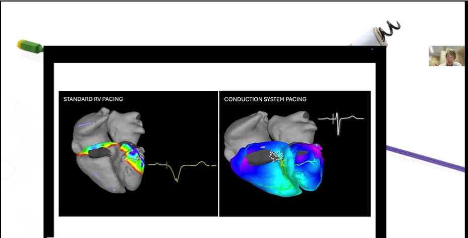 3D activation maps comparing standard RV pacing with Conduction System Pacing electrical synchrony.