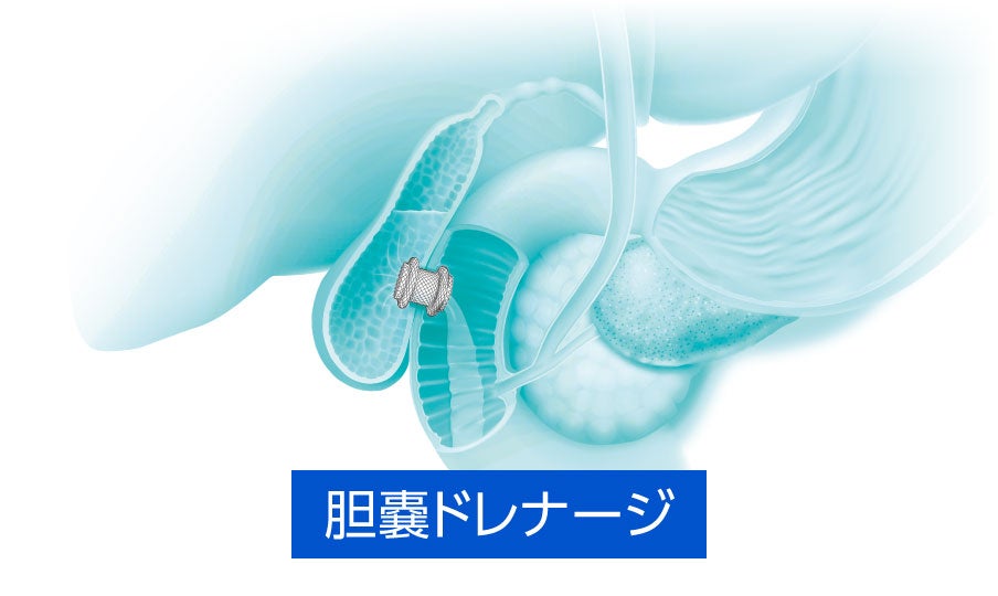 胆嚢ドレナージ