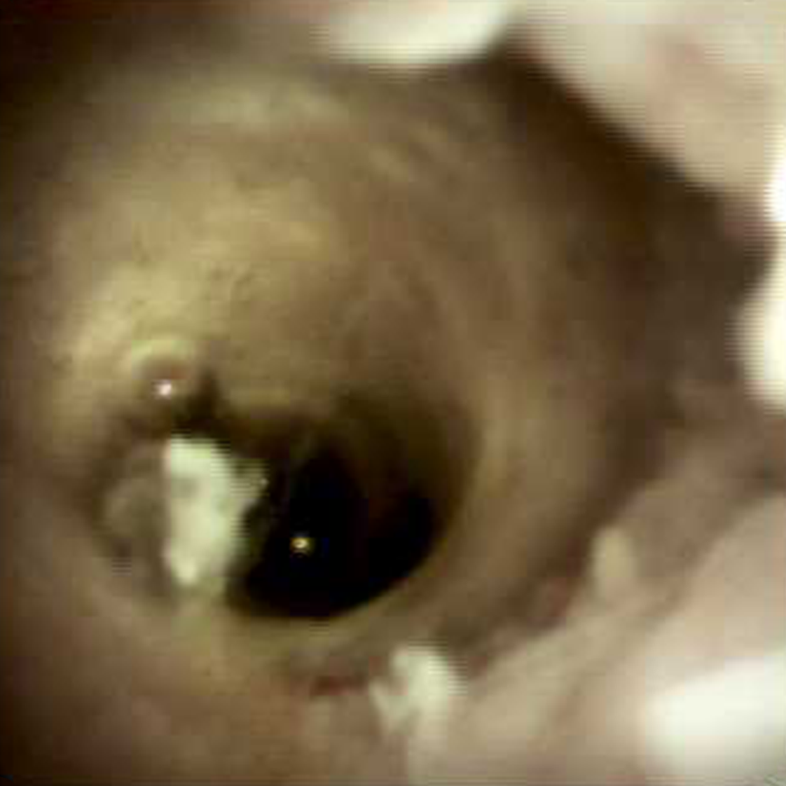 Clinical image of Stone debris (DS I).