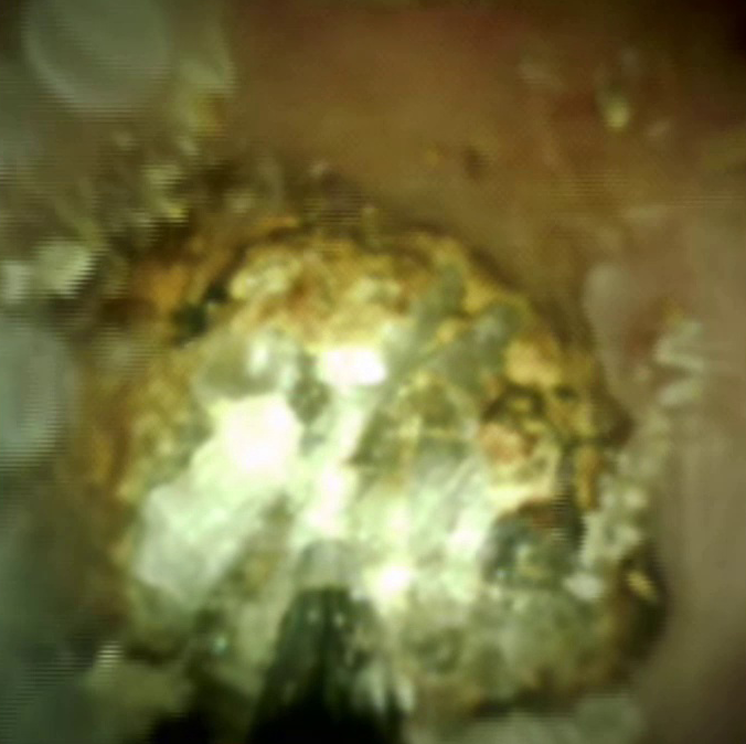 Clinical image of EHL in action.