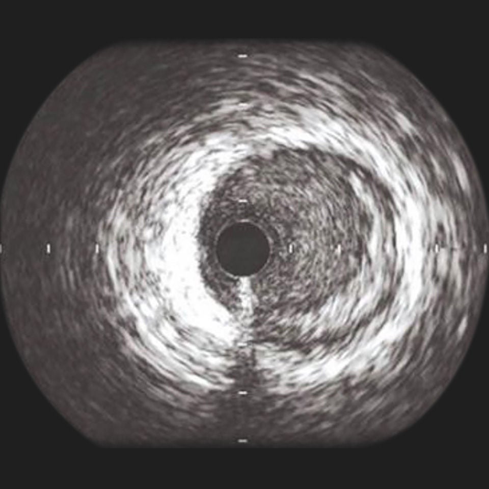 IVUS image of inside a coronary vessel using the 45MHz Philips Volcano Revolution Platinum catheter