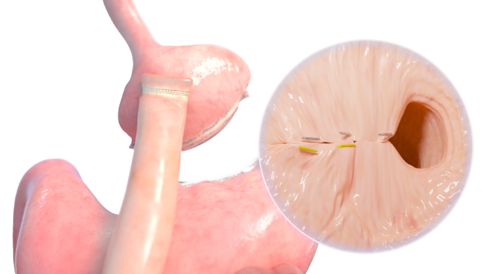 transoral-outlet-reduction-tore