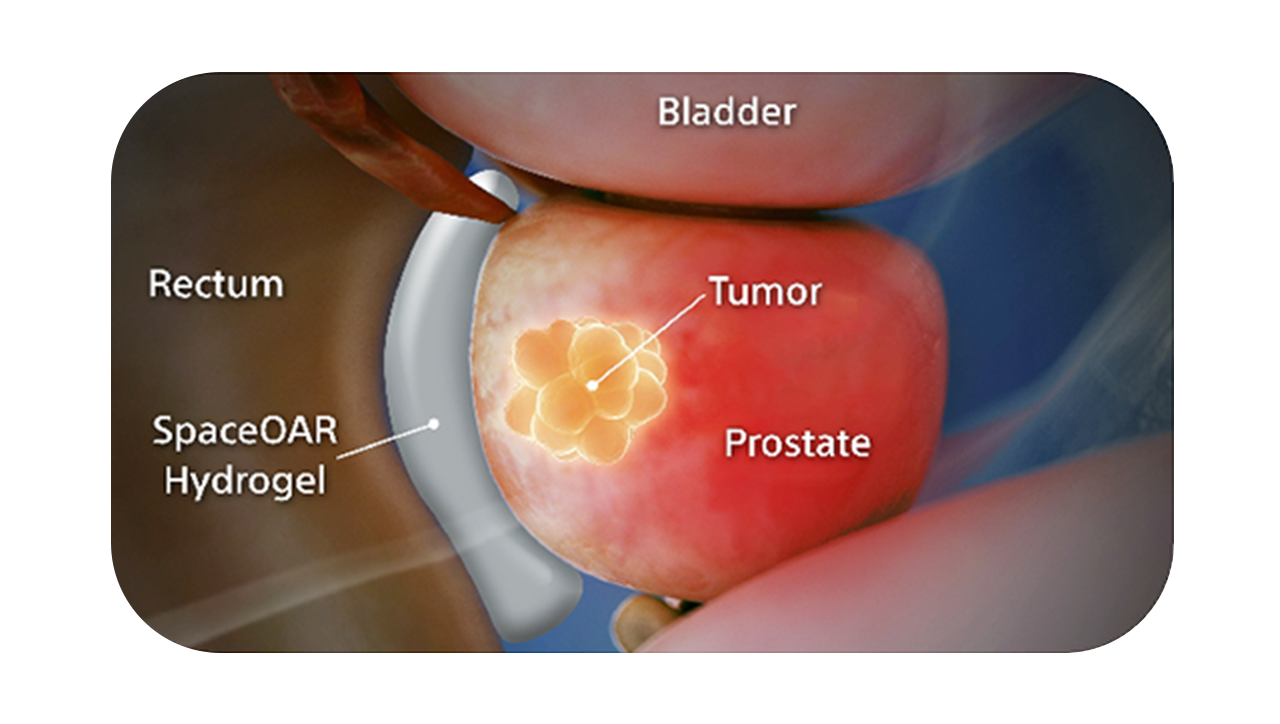 Anatomy illustration with SpaceOAR™ Hydrogel.