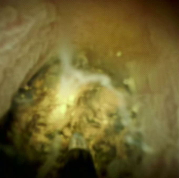 Clinical image of electrohydraulic lithotripsy.