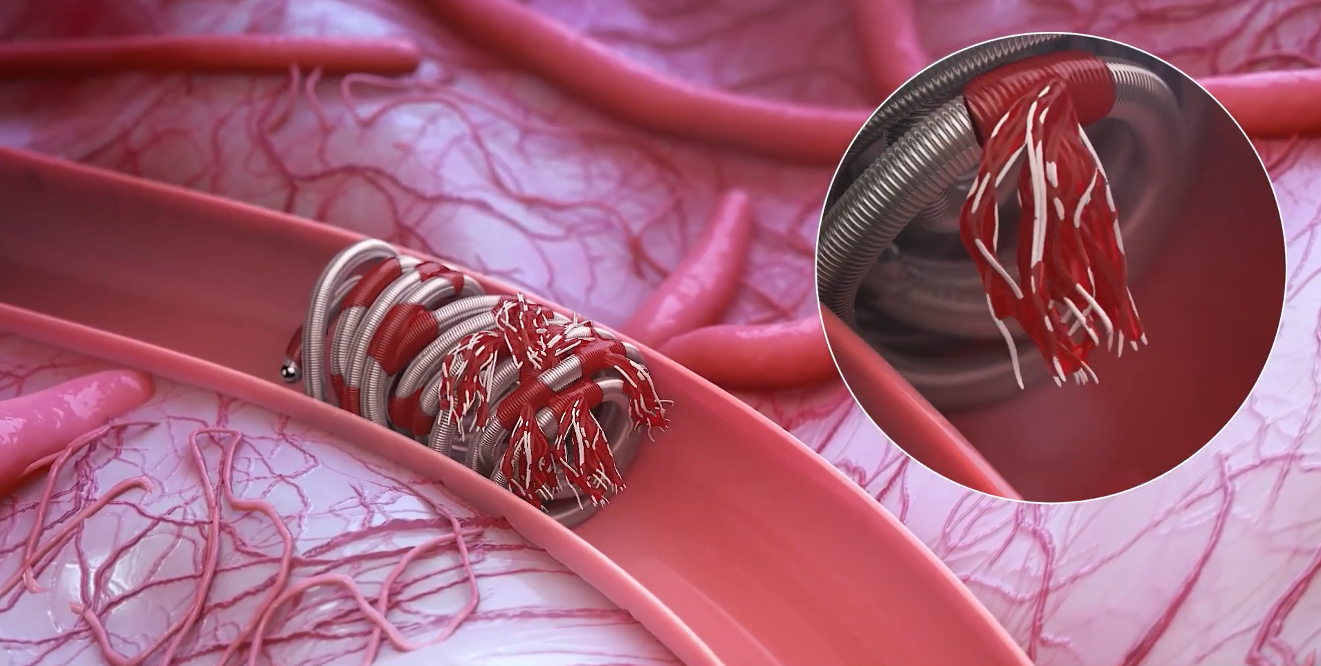 EMBOLD fibered coils product 