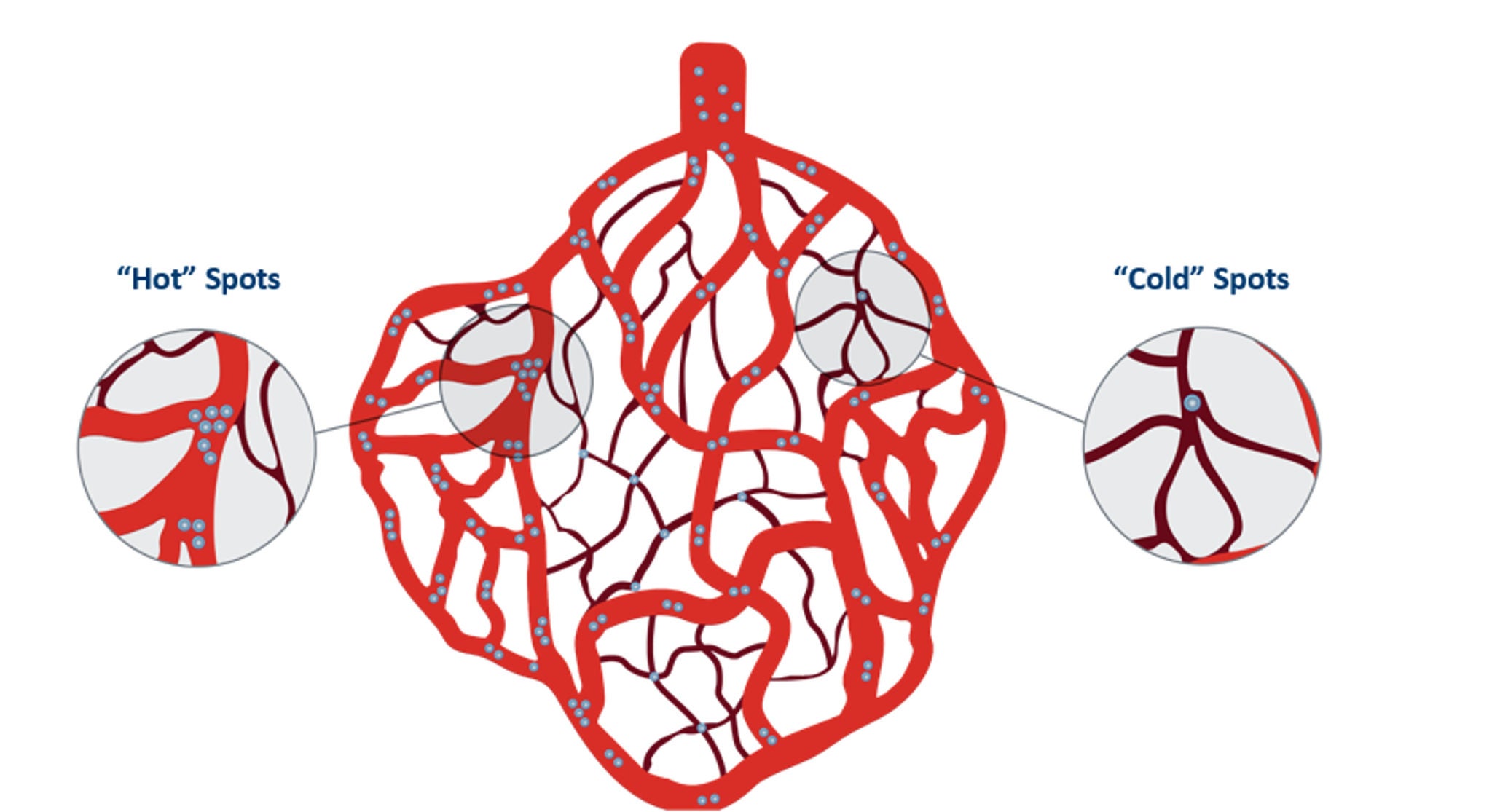 HCC tumours have a complex and heterogenous blood supply, so microspheres distribute unevenly or in clusters