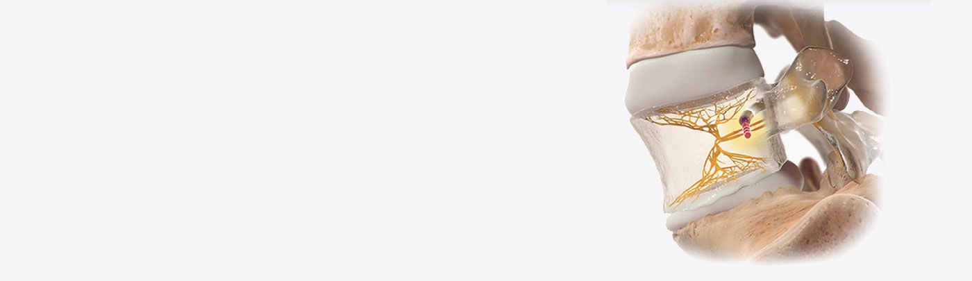 Illustration of spinal vertebra showing probe applying energy to basivertebral nerve.