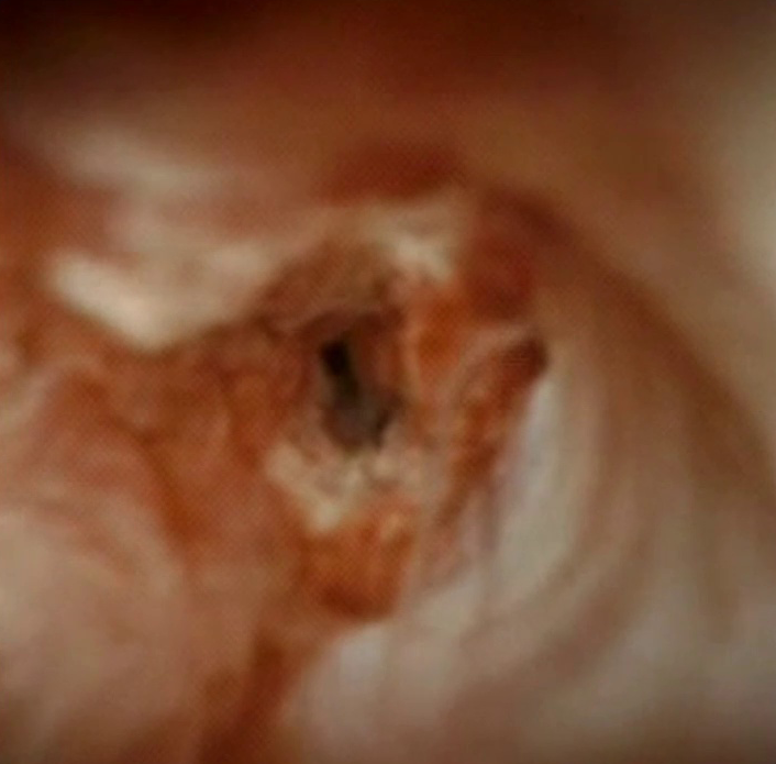 Clinical image of characteristics of a malignant stricture.