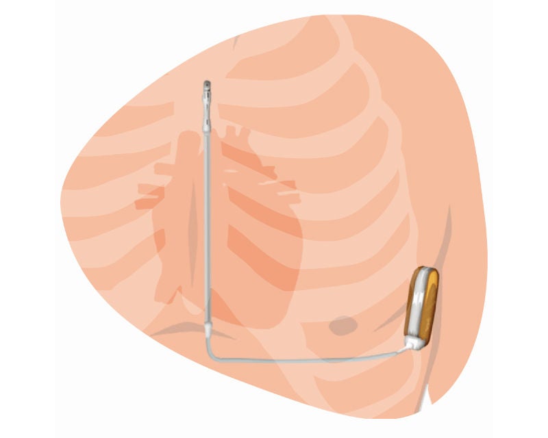 皮下植込み型ICD（S-ICD）