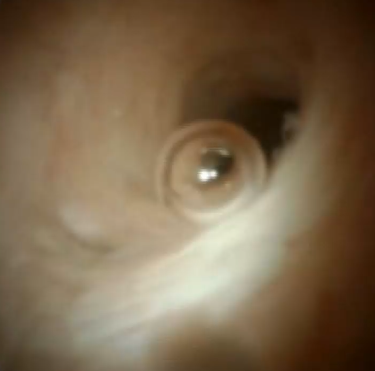 Clinical image of normal pancreas.