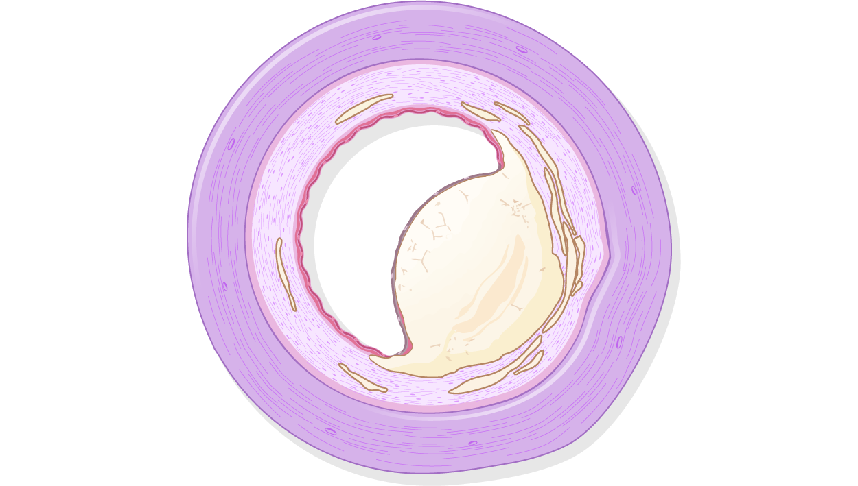 Coronary artery showing nodular calcium.