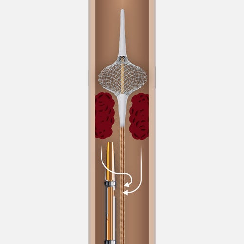 Smart Cateter SmartClaw™ Thrombectomy Catheter - Boston Scientific