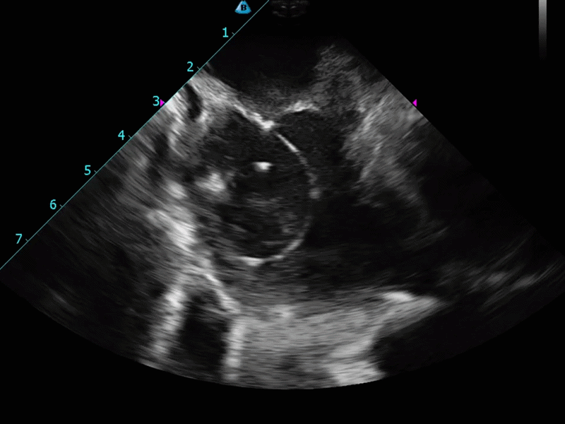 VersaCross Wire with HiViz technology on ultrasound.