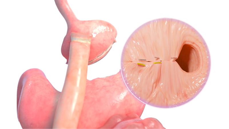 Transoral Outlet Reduction