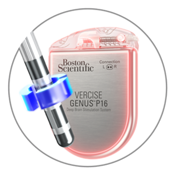 Two graphics showinganodic stimulation; one with a deep brain stimulation lead and the other with IPG.