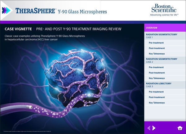 PDF TheraSphere Imaging Case Vignette
