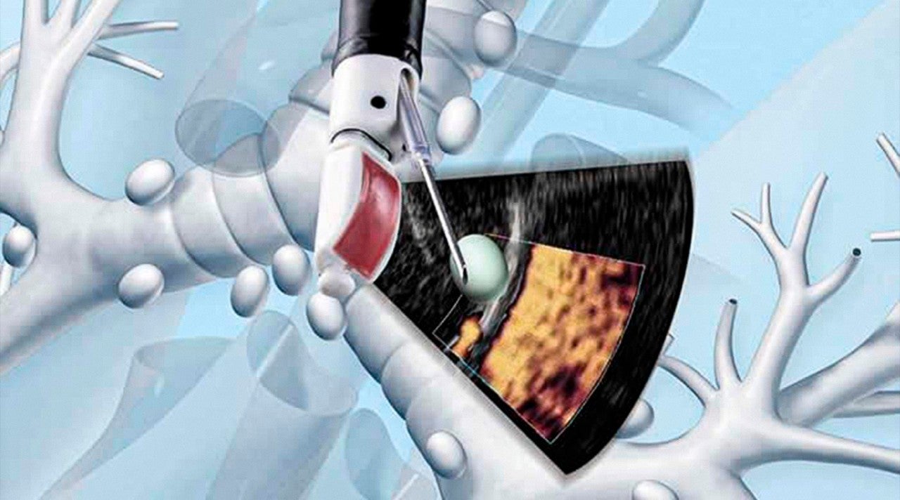Endobronchial Ultrasound