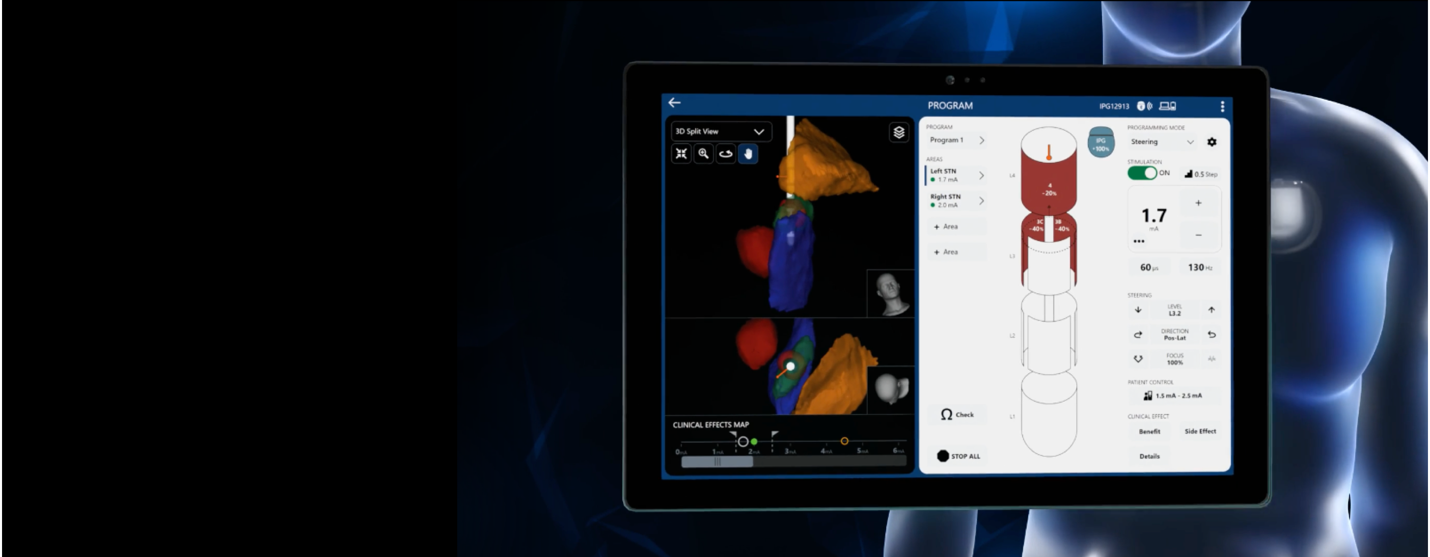 VN5 programming software on tablet screen. IPG implanted in body in background.