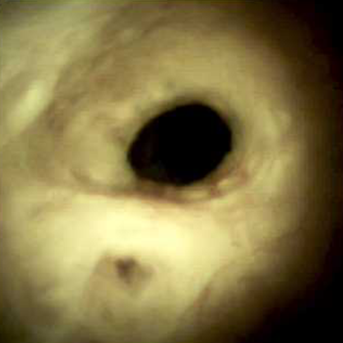 Clinical image of Native cystic duct biliary anastamosis four years (DS I).