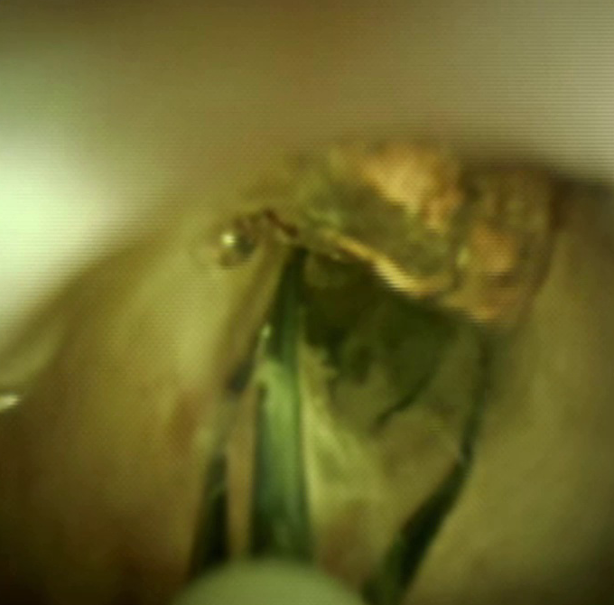 Clinical image of stone basket.