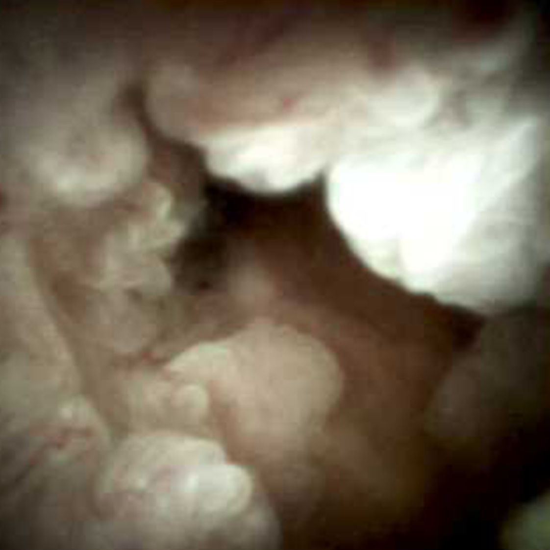 Clinical image of villiform formation.