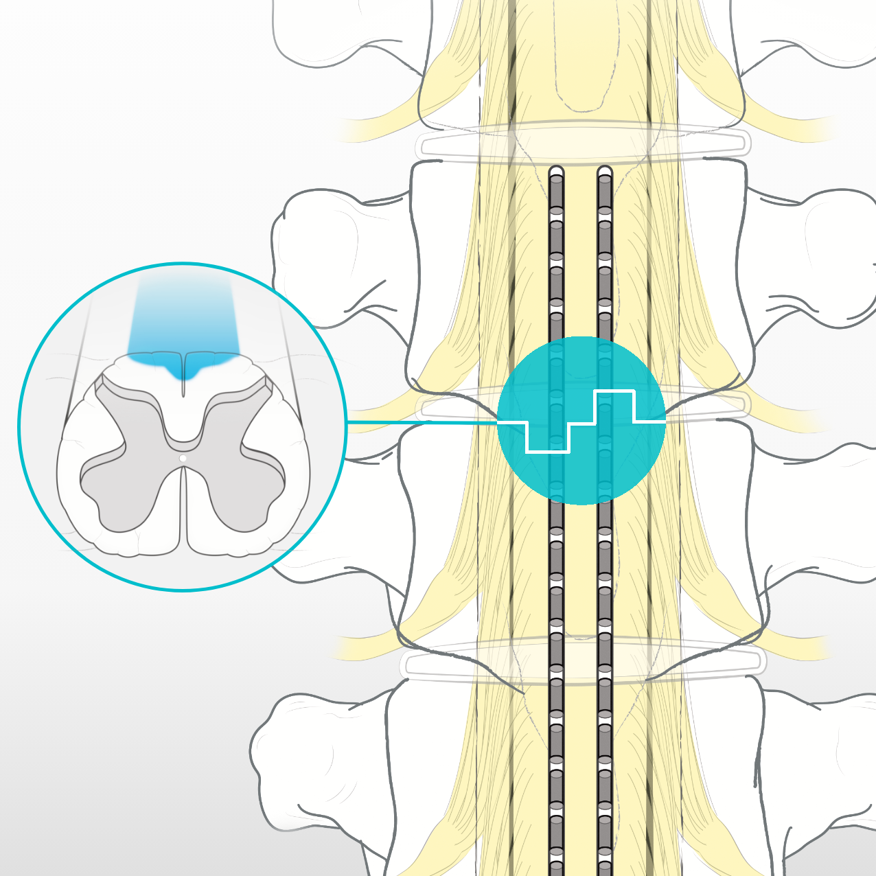 Illustration of spinal cord injury area.