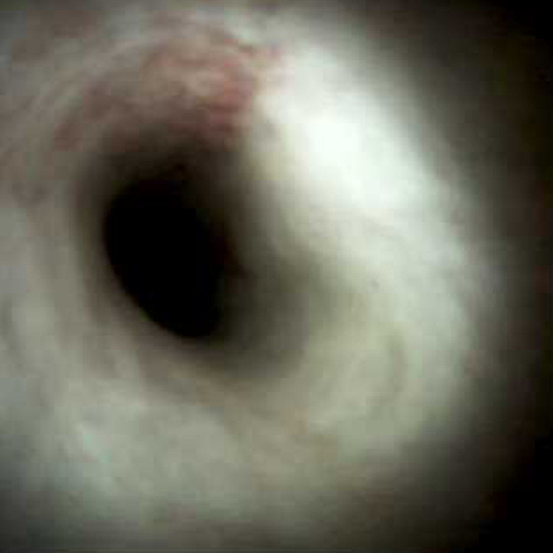 Clinical image of Normal common hepatic duct (DS I).