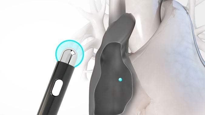 RF electrode tip of NRG Transseptal Needle emitting blue signal, corresponding to blue sphere in diagnostic illustration.