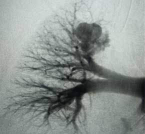 Scan of vein before placement of coil.