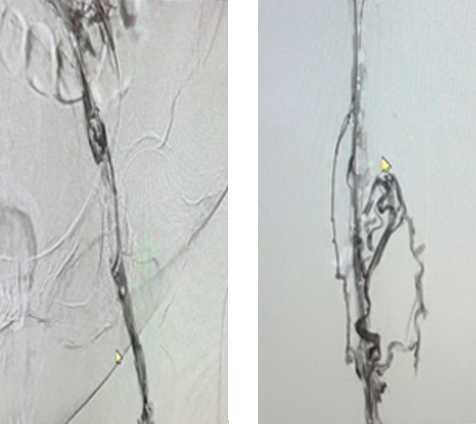 Scan of veins pre-penumbra; pre-smartclaw.