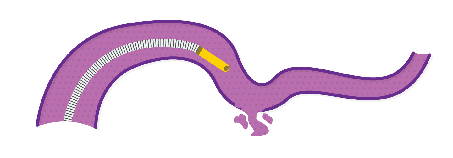 Obsidio conformable slow injection deployment pre delivery.
