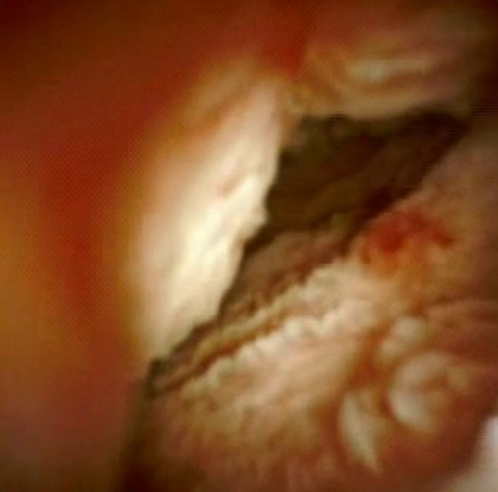 Clinical image of villous lesion.