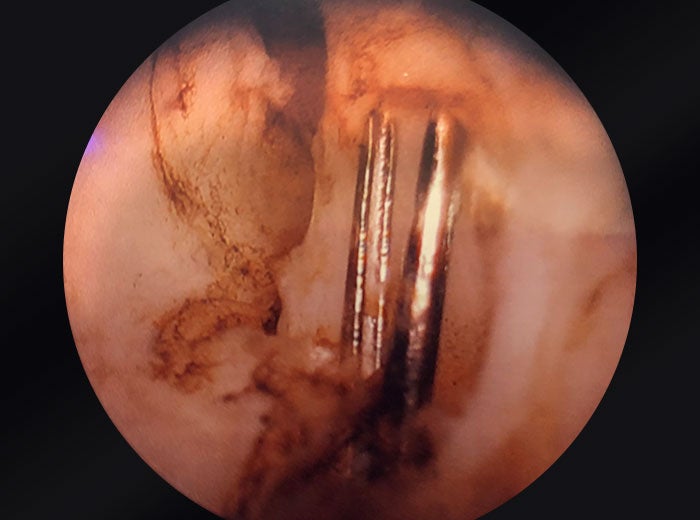 OR camera zoomed into prostate.