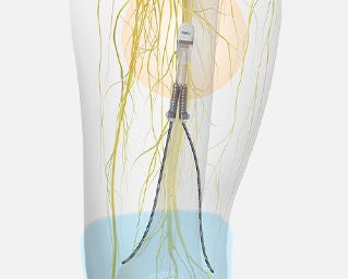 Peripheral Nerve Stimulation