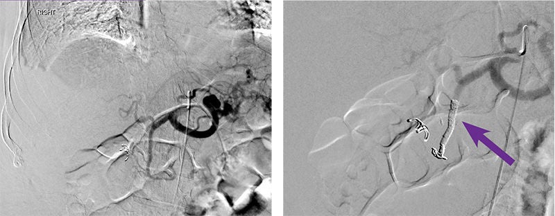 Purple arrows pointing to administration of 0.5 mL of Obsidio Embolic.