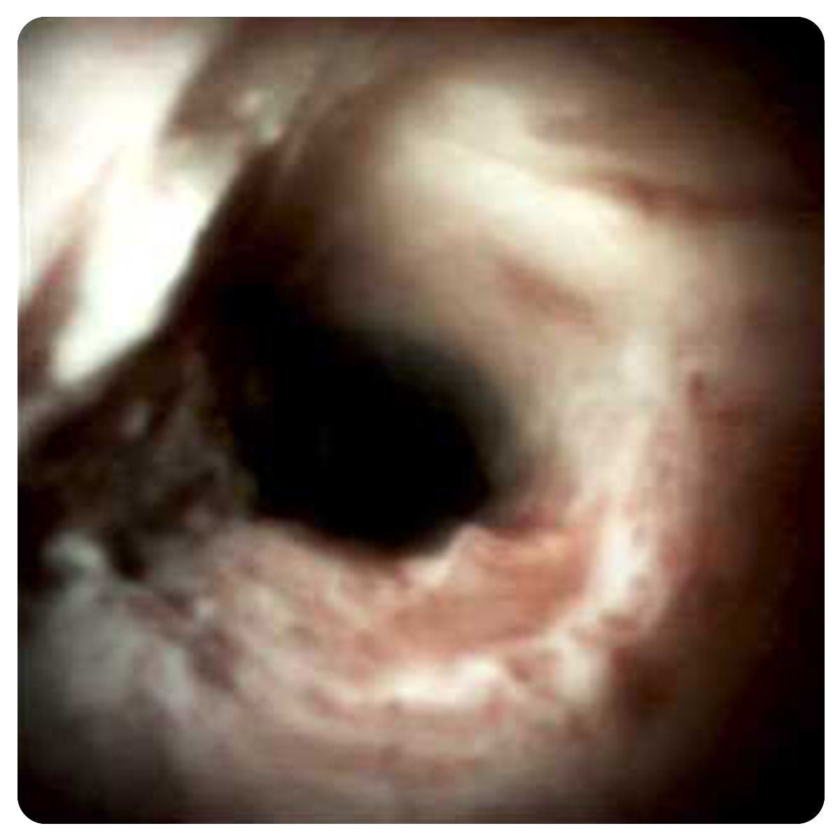 Cholangiocarcinoma
