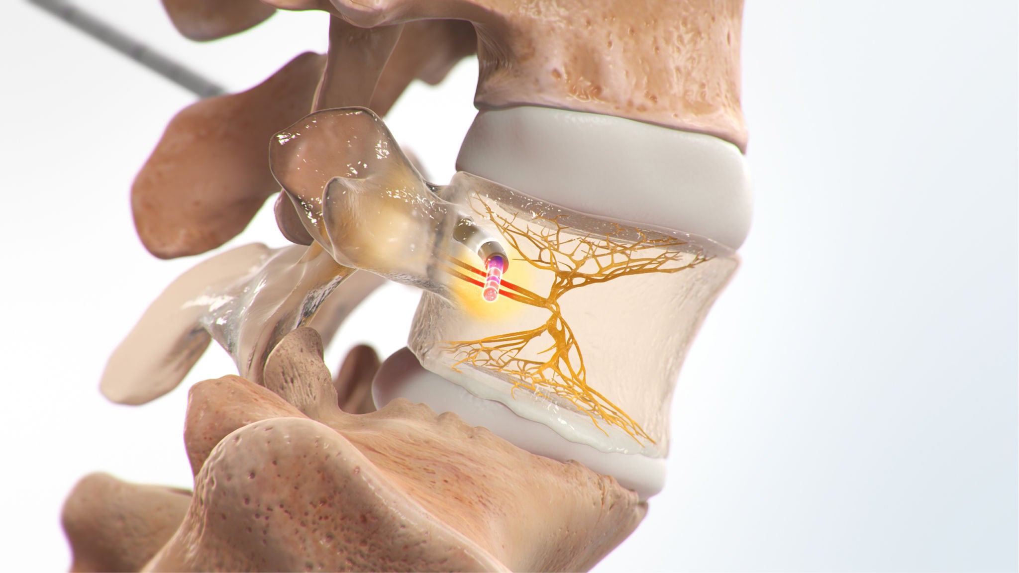 Medical rendering showing vertebral anatomy and Intracept treatment area.