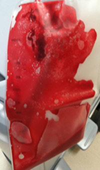 Collection bag after treatment.