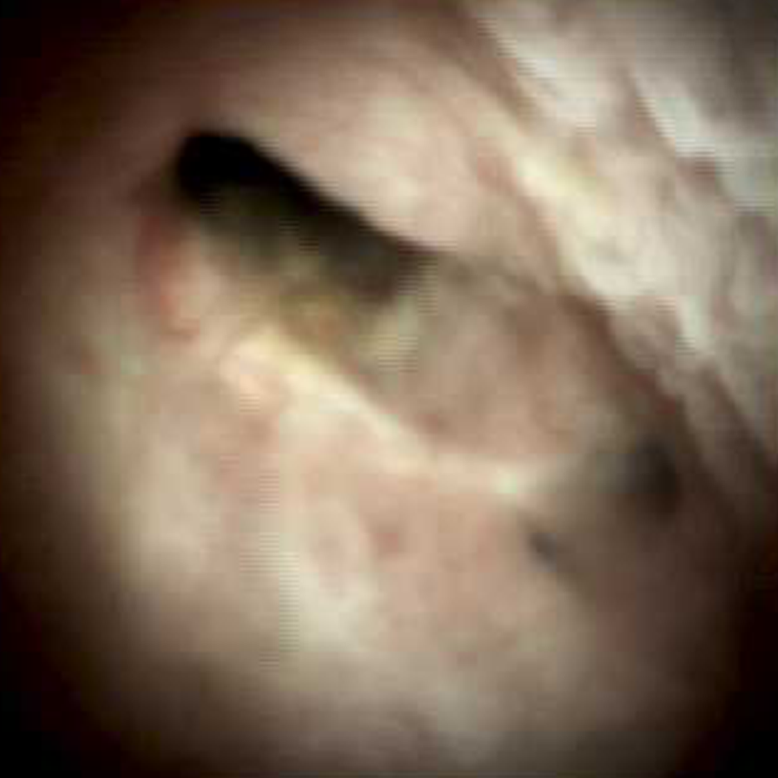 Clinical image of Biliary anastamosis two years (DS I).